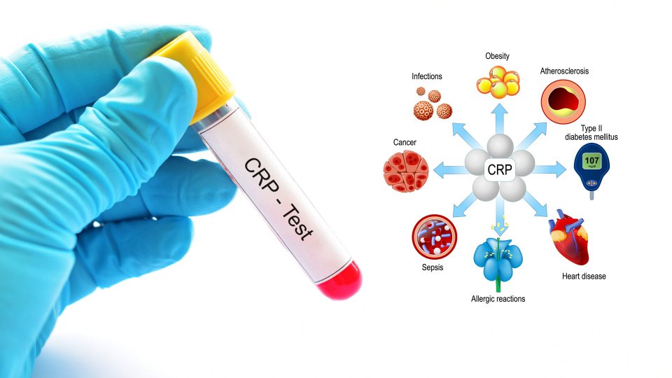 C-Reaktif Protein (CRP) Nedir?